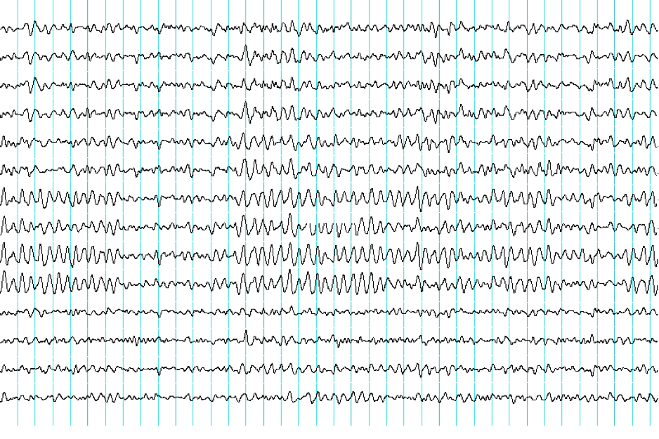 electroencephalography eeg sydney neurology electroencephalography